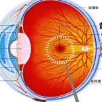 增龄性黄斑变性